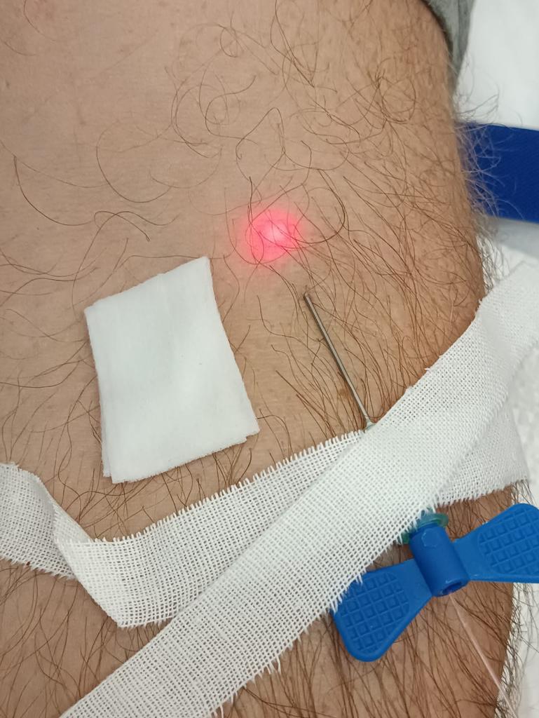 На фото внутривенное лазерное облучение крови